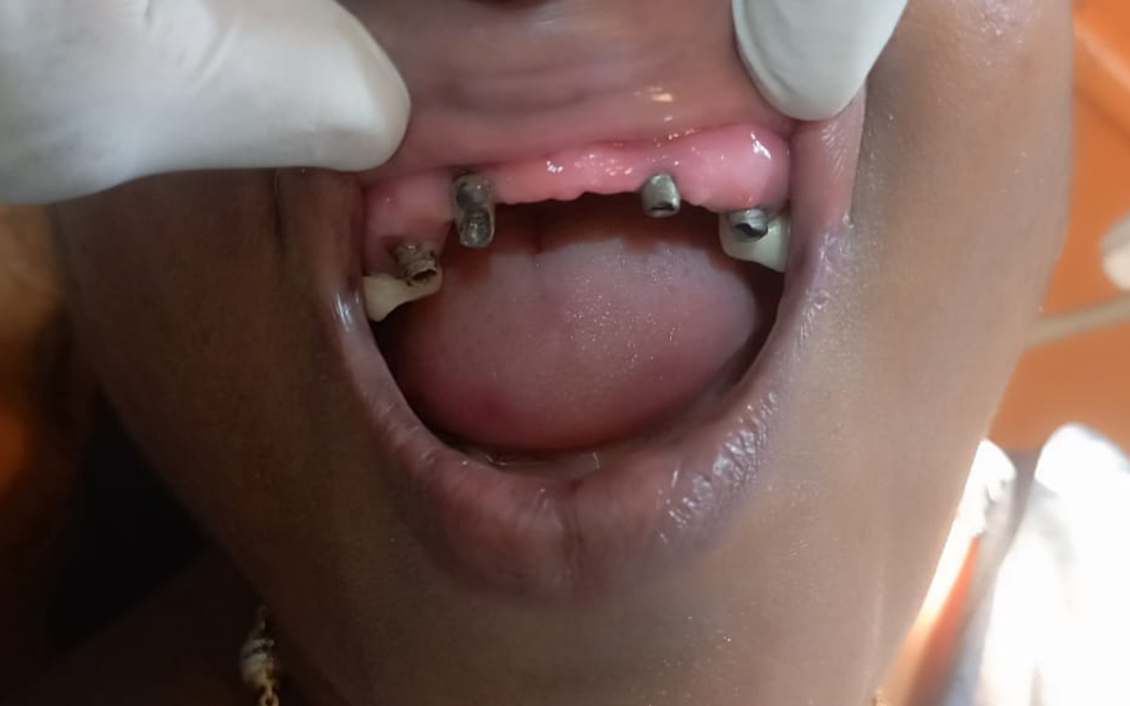 Scaling & Polishing before