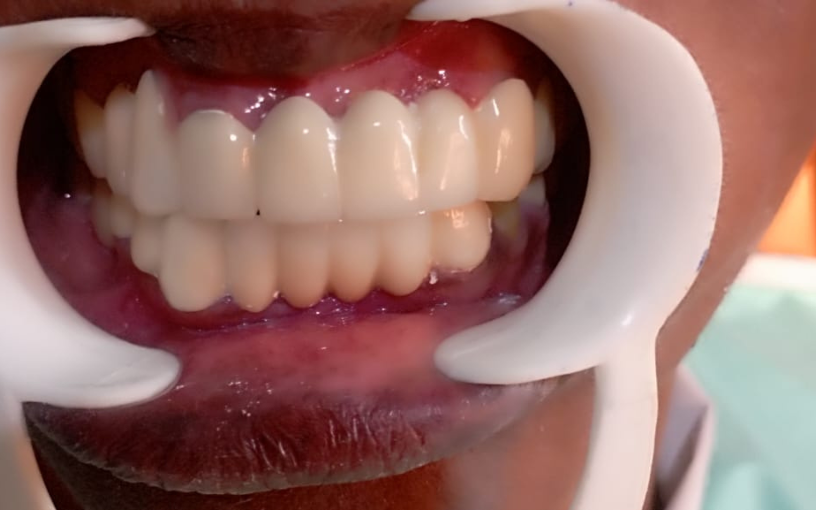 Tooth extraction after